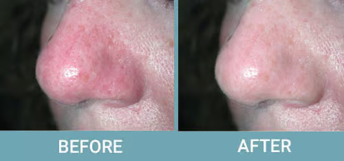 Facial-Thread-Vein-Removal-before-after-1.jpg