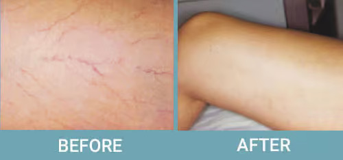 Facial-Thread-Vein-Removal-before-after.jpg