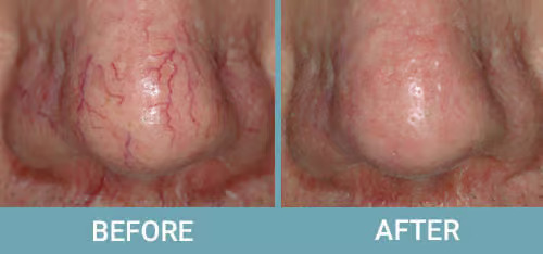 Facial-Thread-Vein-Removal-before-after1-1.jpg