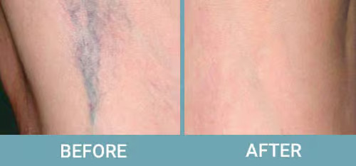 Facial-Thread-Vein-Removal-before-after1.jpg