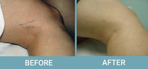 Facial-Thread-Vein-Removal-before-after2.jpg