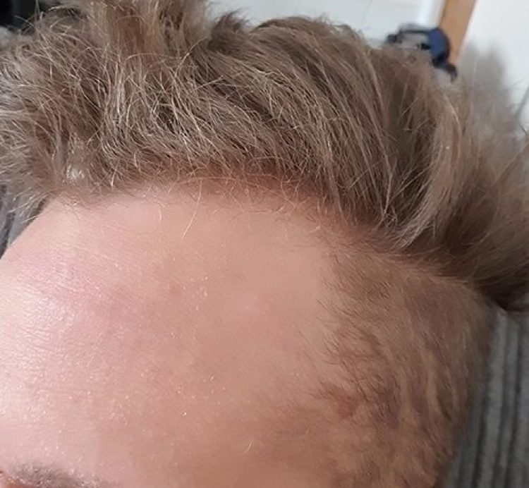 After-Forehead-Cyst-Removal-e1763651797156.jpg