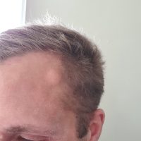 Cyst-Before-scaled-1.jpg