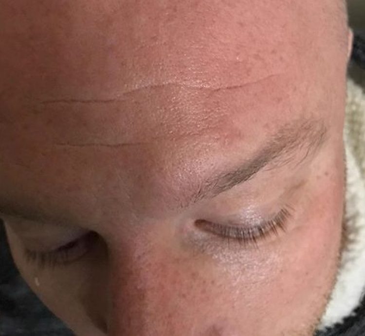 Forehead-Cyst-After-Removal-e1763652920852.jpg