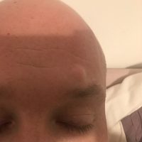 Forehead-Cyst-before-removal.jpg
