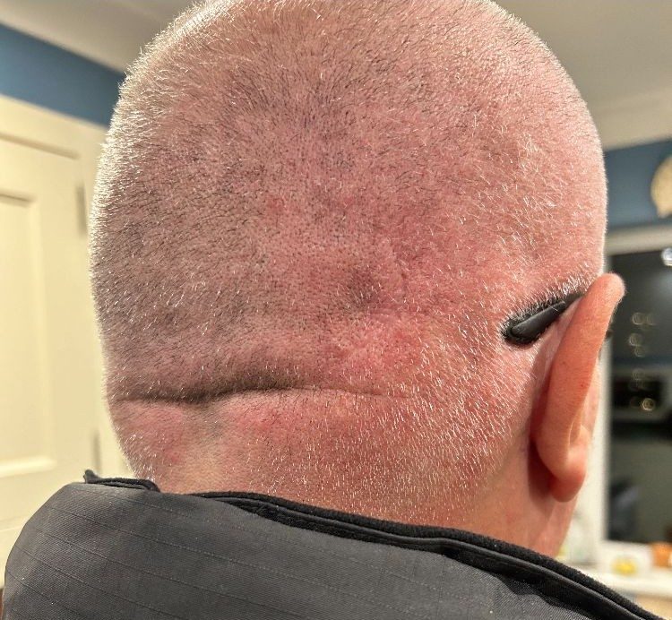 Lump-Surgery-After.jpeg