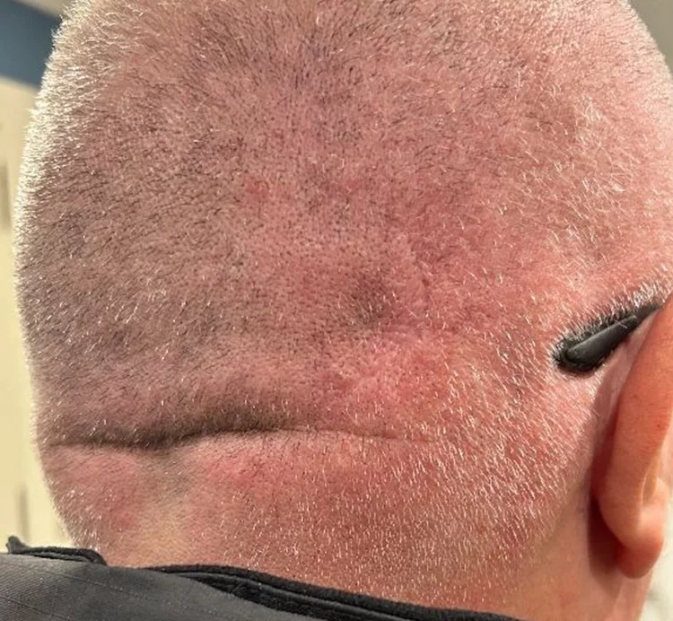 Lump-Surgery-After.webp