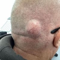 Lump-Surgery-Before.jpeg