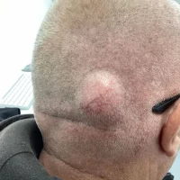 Lump-Surgery-Before.webp