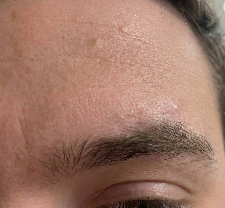 after-image-eyebrow-cyst.png