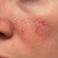 before-facial-veins-scaled-e1764099737702.png