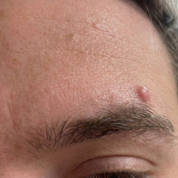 before-image-eyebrow-cyst.png