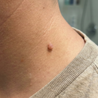 before-skin-tag-scaled-e1764098431428.png