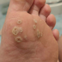 warts-before-scaled-e1764099446730.png